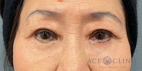 眼瞼下垂｜症例105｜70代女性｜術後1ヶ月後｜エースクリニック大阪梅田HEPナビオ院