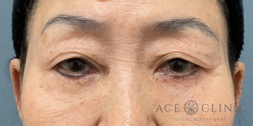 眼瞼下垂｜症例105｜70代女性｜術前｜エースクリニック大阪梅田HEPナビオ院