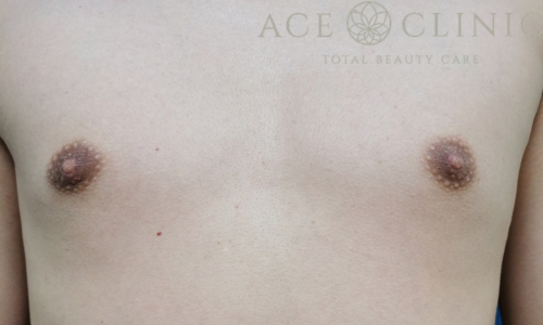 乳頭縮小｜症例57｜40代女性｜術後｜エースクリニック大阪梅田HEPナビオ院