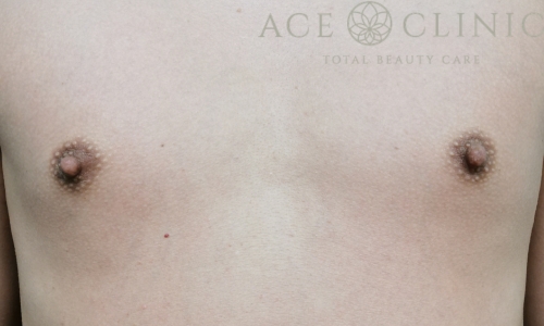 乳頭縮小｜症例57｜40代女性｜術前｜エースクリニック大阪梅田HEPナビオ院