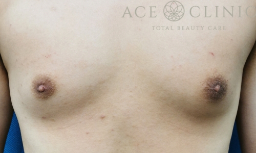 乳頭縮小｜症例58｜30代男性｜術後｜エースクリニック大阪梅田HEPナビオ院