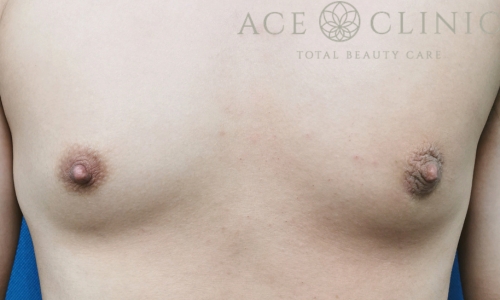 乳頭縮小｜症例58｜30代男性｜術前｜エースクリニック大阪梅田HEPナビオ院