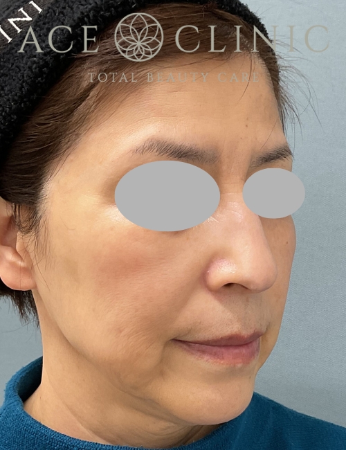 ルビーフラクショナル｜症例8｜60代女性｜術後｜エースクリニック大阪梅田HEPナビオ院
