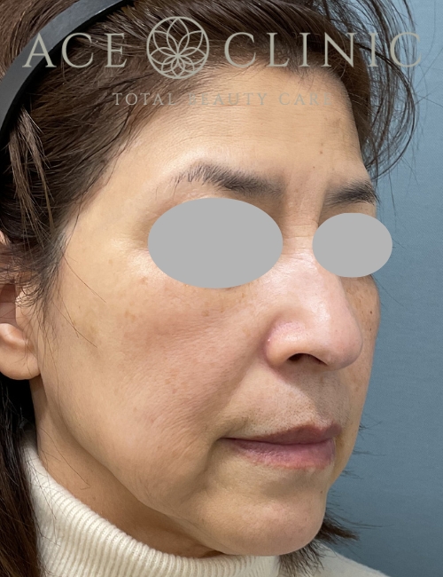 ルビーフラクショナル｜症例8｜60代女性｜術前｜エースクリニック大阪梅田HEPナビオ院