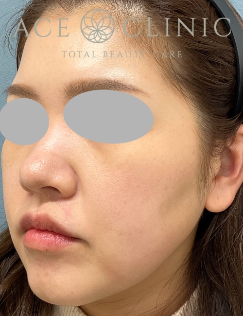 ルビーフラクショナル｜症例9｜30代女性｜術後｜エースクリニック大阪梅田HEPナビオ院