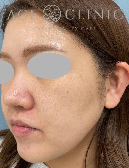 ルビーフラクショナル｜症例9｜30代女性｜術前｜エースクリニック大阪梅田HEPナビオ院