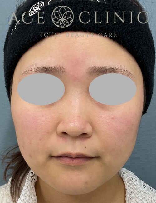 オンダリフト｜症例9｜20代女性｜術後｜エースクリニック大阪梅田HEPナビオ院