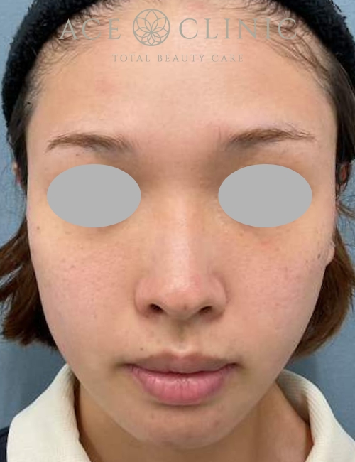 アドバテックスレーザー|症例8|20代女性|術後|エースクリニック大阪梅田HEPナビオ院