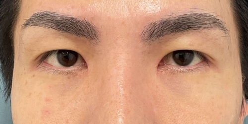 目頭切開｜症例8｜30代男性｜術後｜エースクリニック大阪梅田HEPナビオ院