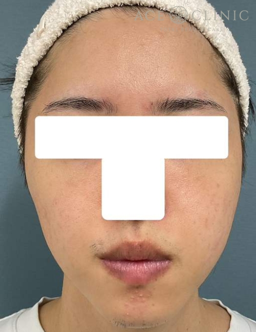 脂肪注入|症例13|30代男性|術後|エースクリニック大阪梅田HEPナビオ院