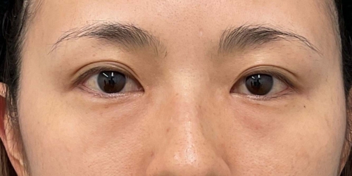 経結膜ハムラ法｜症例64｜40代女性｜術前｜エースクリニック大阪梅田HEPナビオ院