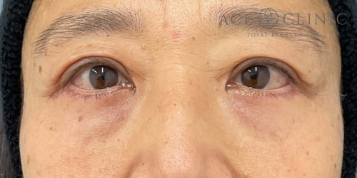 皮切りハムラ法＋眼瞼挙筋前転法｜症例2｜50代女性｜術後｜エースクリニック大阪梅田HEPナビオ院