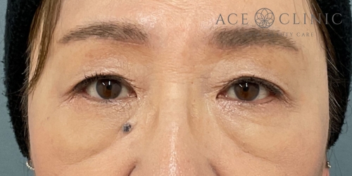 眉毛下切開法｜症例56｜60代女性｜術後｜エースクリニック大阪梅田HEPナビオ院