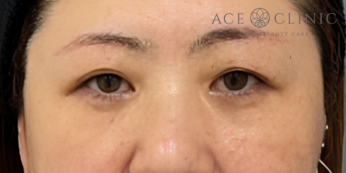 眉毛下切開｜症例57｜50代女性｜術後｜エースクリニック大阪梅田HEPナビオ院