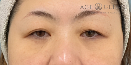 眉毛下切開｜症例57｜50代女性｜術前｜エースクリニック大阪梅田HEPナビオ院