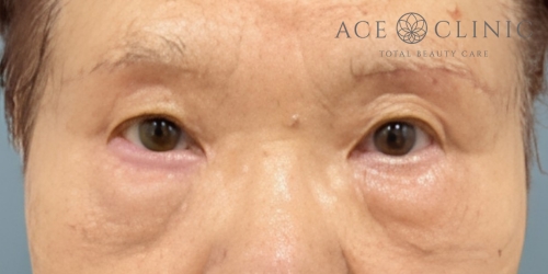 眉毛下切開｜症例58｜80代女性｜術後｜エースクリニック大阪梅田HEPナビオ院
