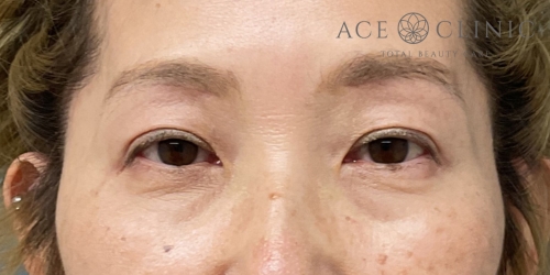 眉毛下切開法＋二重埋没法｜症例19｜50代女性｜術後｜エースクリニック大阪梅田HEPナビオ院