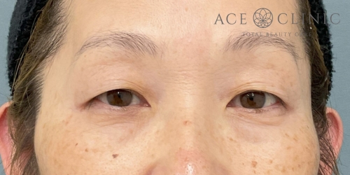眉毛下切開法＋二重埋没法｜症例19｜50代女性｜術前｜エースクリニック大阪梅田HEPナビオ院