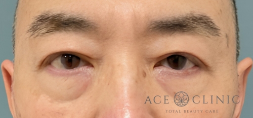 眼瞼挙筋前転｜症例105｜50代男性｜術後｜エースクリニック大阪梅田HEPナビオ院