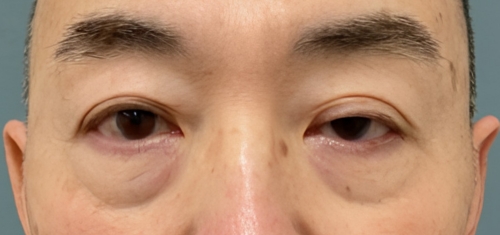 眼瞼挙筋前転｜症例105｜50代男性｜術前｜エースクリニック大阪梅田HEPナビオ院