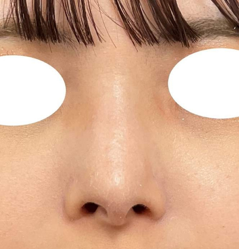 鼻尖形成＋鼻翼縮小術｜症例12｜20代女性｜術後｜エースクリニック大阪梅田HEPナビオ院