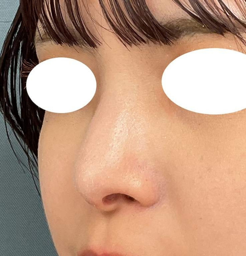 鼻尖形成＋鼻翼縮小術｜症例12｜20代女性｜術後｜エースクリニック大阪梅田HEPナビオ院