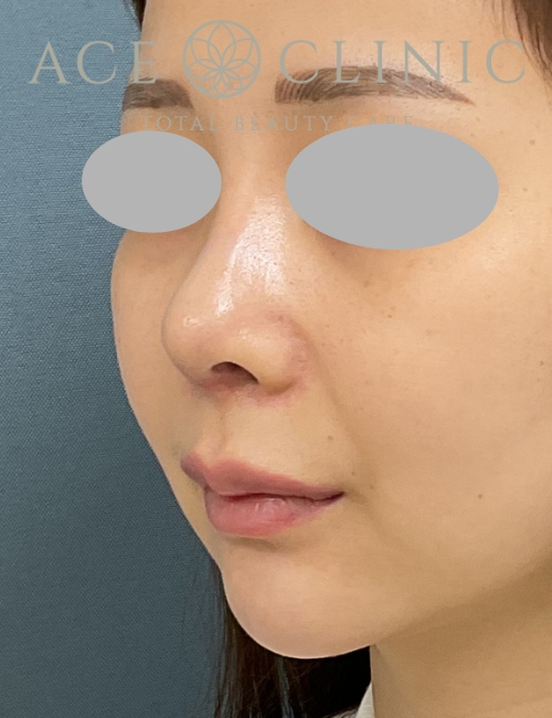 鼻プロテーゼ入替＋鼻中隔延長｜症例13｜20代女性｜術後｜エースクリニック大阪梅田HEPナビオ院