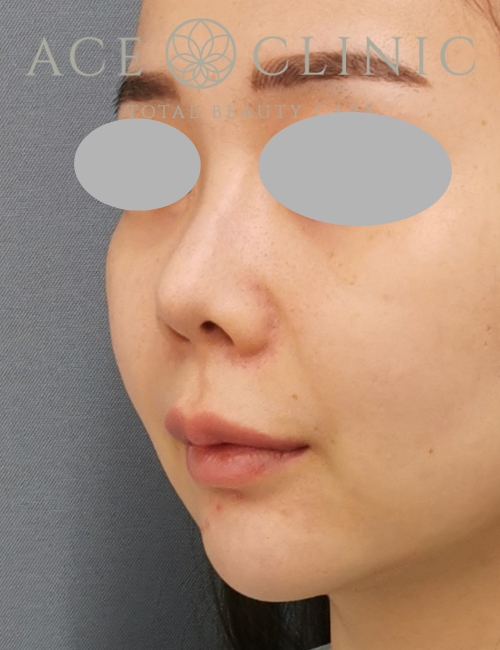 鼻プロテーゼ入替＋鼻中隔延長｜症例13｜20代女性｜術前｜エースクリニック大阪梅田HEPナビオ院