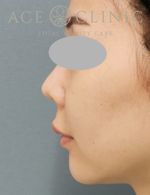 鼻プロテーゼ入替＋鼻中隔延長｜症例13｜20代女性｜術前｜エースクリニック大阪梅田HEPナビオ院