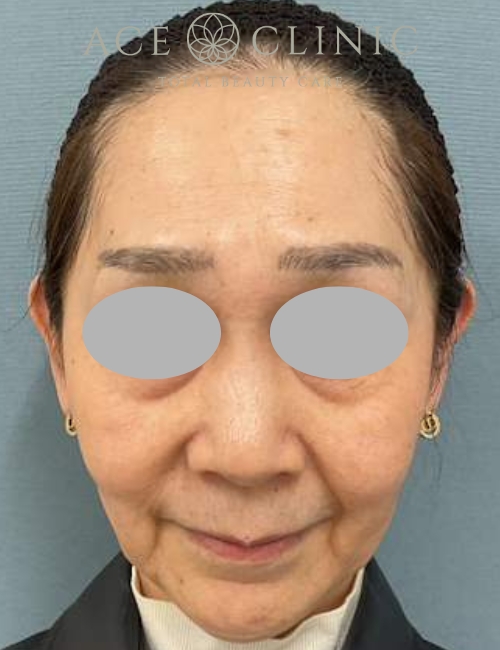 ルビーフラクショナル|症例12|60代女性|術前|エースクリニック大阪梅田HEPナビオ院