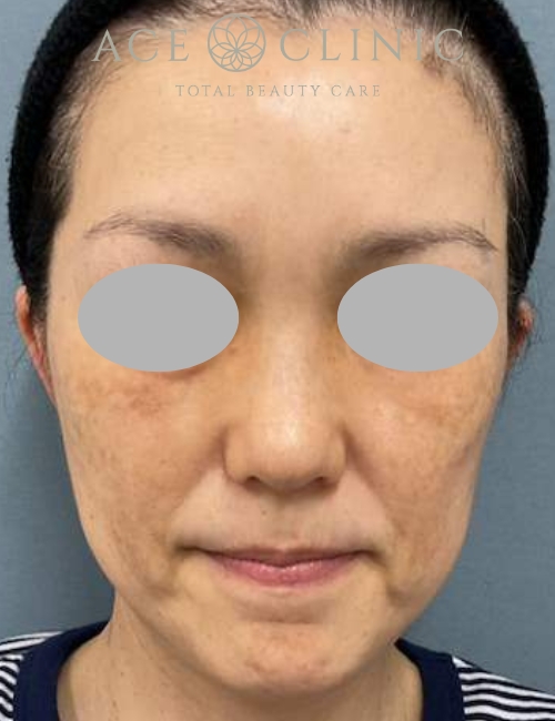 ルビーフラクショナル|症例15|50代女性|術後|エースクリニック大阪梅田HEPナビオ院