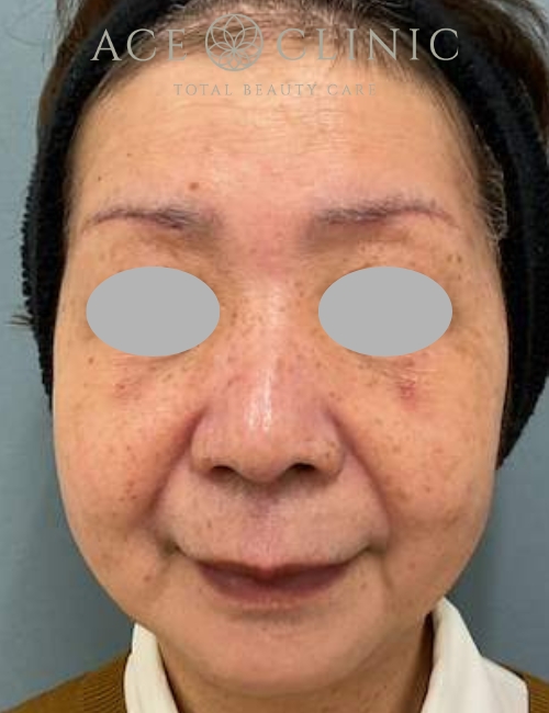 ルビーフラクショナル|症例16|60代女性|術前|エースクリニック大阪梅田HEPナビオ院