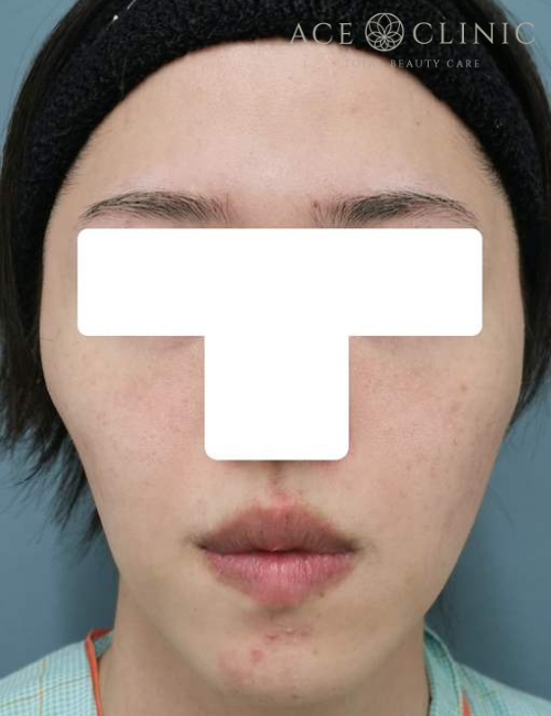 脂肪注入|症例13|30代男性|術前|エースクリニック大阪梅田HEPナビオ院