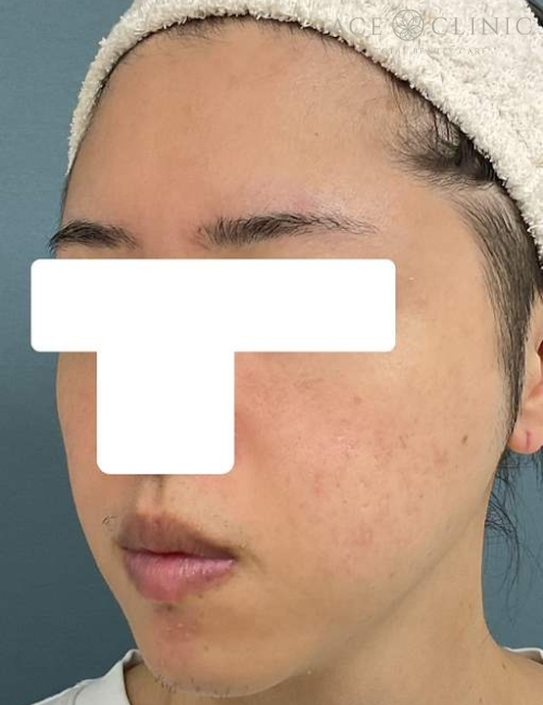 脂肪注入|症例13|30代男性|術後|エースクリニック大阪梅田HEPナビオ院