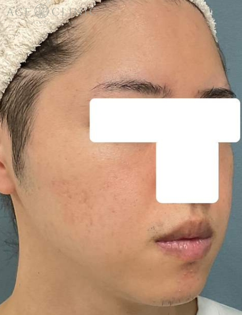 脂肪注入|症例13|30代男性|術後|エースクリニック大阪梅田HEPナビオ院
