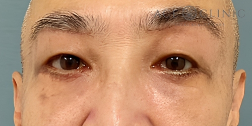 皮切りハムラ法｜症例29｜60代男性｜術後｜エースクリニック大阪梅田HEPナビオ院