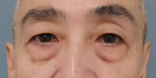 皮切りハムラ法｜症例29｜60代男性｜術前｜エースクリニック大阪梅田HEPナビオ院