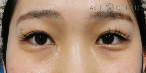 二重まぶた全切開法｜症例16｜20代女性｜術後｜エースクリニック大阪梅田HEPナビオ院