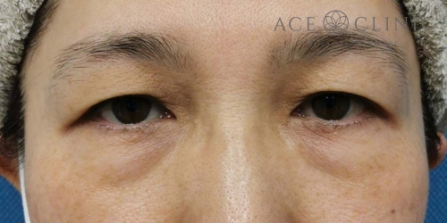 眉毛下切開法|症例59|50代女性|術前|エースクリニック大阪梅田HEPナビオ院