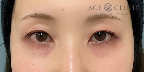 二重まぶた埋没法|症例69|20代女性|術前|エースクリニック大阪梅田HEPナビオ院