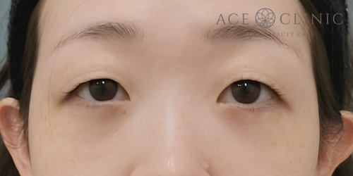 二重まぶた埋没法|症例70|30代女性|術前|エースクリニック大阪梅田HEPナビオ院