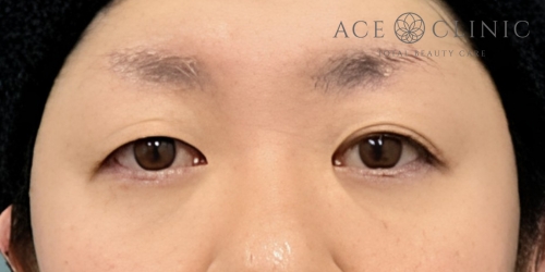 二重まぶた埋没法|症例73|30代女性|術前|エースクリニック大阪梅田HEPナビオ院