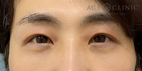 眼瞼挙筋前転法|症例107|60代男性|術後|エースクリニック大阪梅田HEPナビオ院