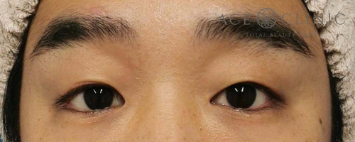 眼瞼挙筋前転法|症例109|30代男性|術後|エースクリニック大阪梅田HEPナビオ院