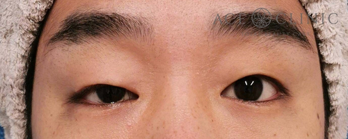 眼瞼挙筋前転法|症例109|30代男性|術前|エースクリニック大阪梅田HEPナビオ院