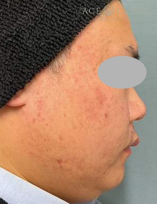 ポテンツァ+トライフィルプロ|症例3|30代男性|術後|エースクリニック大阪梅田HEPナビオ院