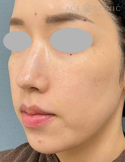 水光注射|症例1|30代女性|術後|エースクリニック大阪梅田HEPナビオ院