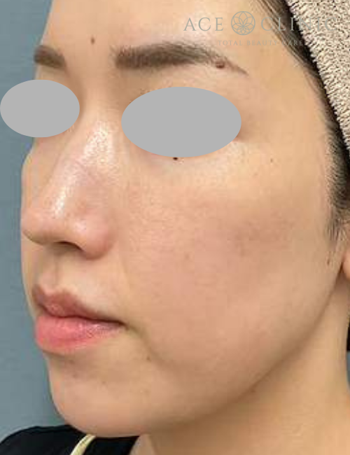 水光注射|症例1|30代女性|術前|エースクリニック大阪梅田HEPナビオ院
