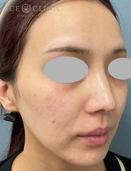 水光注射｜症例2｜30代女性｜術前｜エースクリニック大阪梅田HEPナビオ院