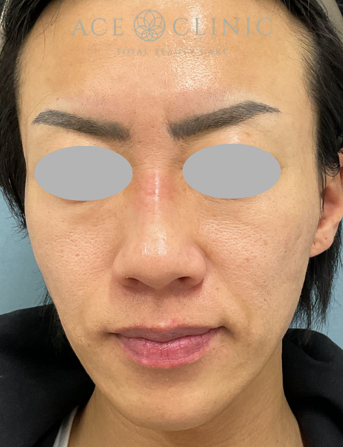 ブレッシング｜症例1｜40代男性｜術前｜エースクリニック大阪梅田HEPナビオ院